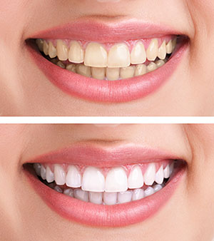 Laser Teeth Whitening | Kingfisher Dental Designs | Dentist in Kingfisher, OK 73750